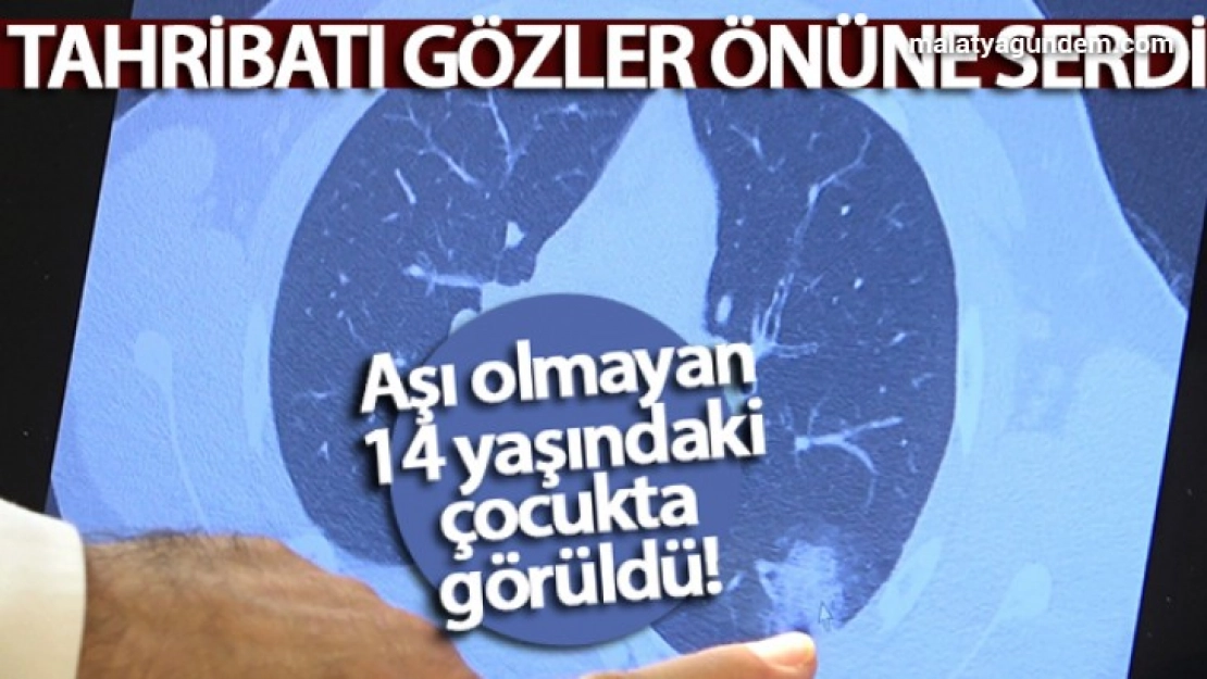Aşı olmayan 14 yaşındaki çocukta ciddi akciğer tutulumları görüldü