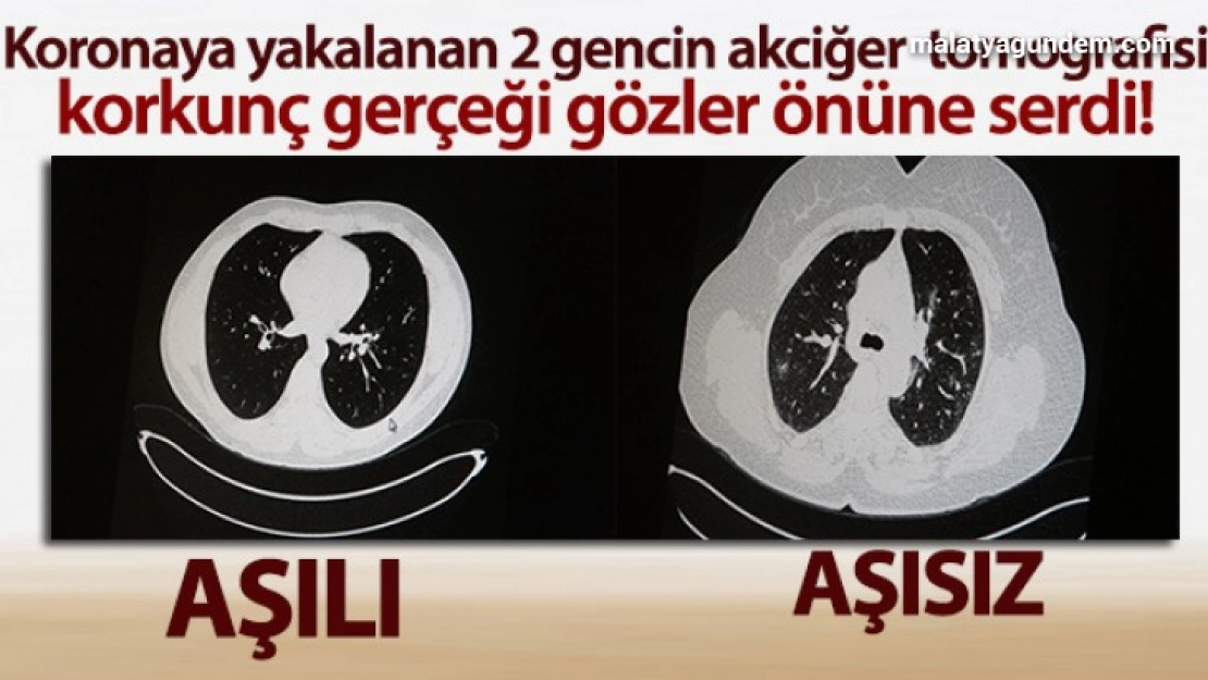 Aşılı ve aşısız olarak koronaya yakalanan 2 gencin akciğer tomografisi gerçeği gözler önüne serdi