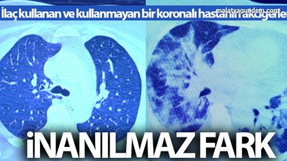 İlaç kullanan korona hastaları ile kullanmayanlar arasındaki inanılmaz fark