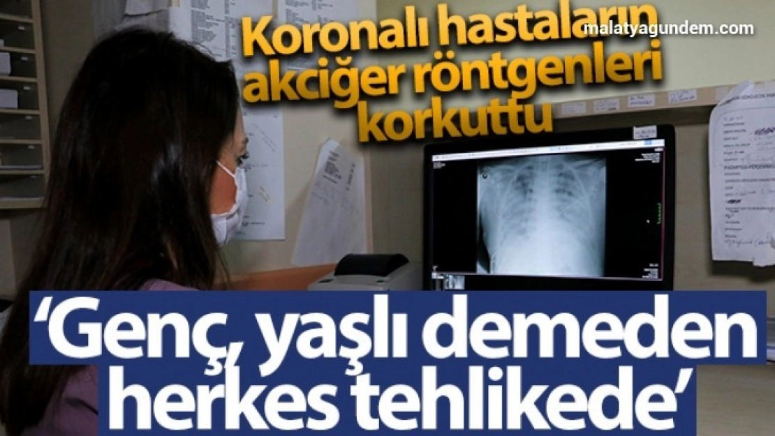 Koronalı hastaların akciğer röntgenleri korkuttu
