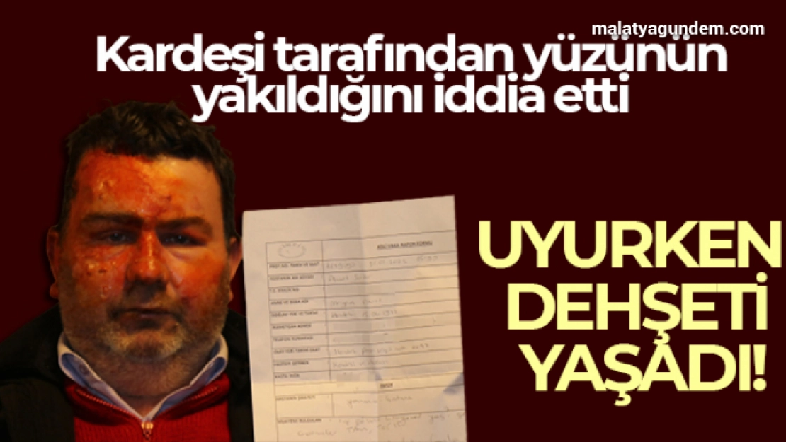 Uyurken dehşeti yaşadı: Kardeşi tarafından yüzünün yakıldığını iddia etti