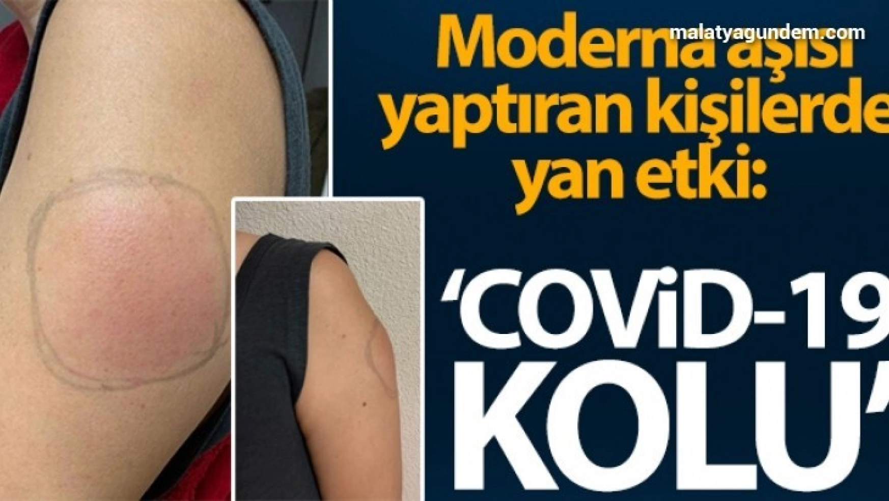 ABD'de Moderna aşısı yaptıran kişilerde yan etki: 'Covid-19 kolu'