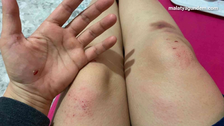 İşe giden kadına köpekler saldırdı