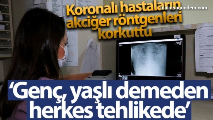 Koronalı hastaların akciğer röntgenleri korkuttu